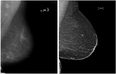 Impact of multi-source data augmentation on performance of convolutional neural networks for abnormality classification in mammography
